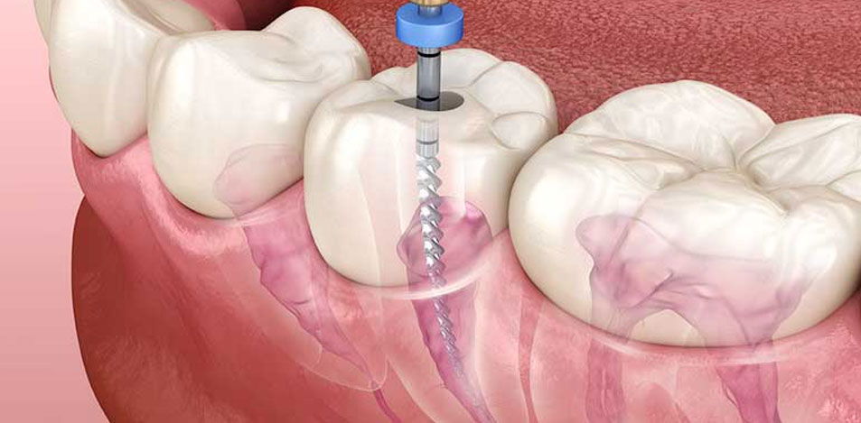 Root Canal Treatment